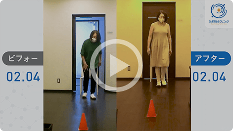 患者様の治療前後の歩行比較動画2